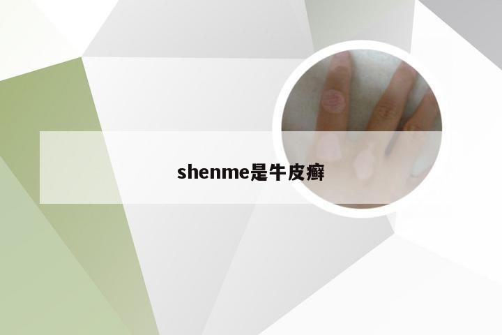 shenme是牛皮癣