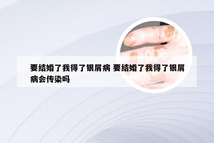 要结婚了我得了银屑病 要结婚了我得了银屑病会传染吗