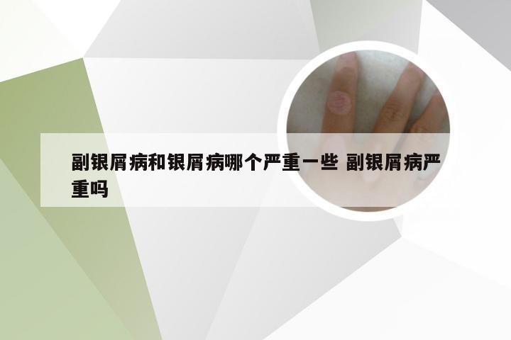 副银屑病和银屑病哪个严重一些 副银屑病严重吗