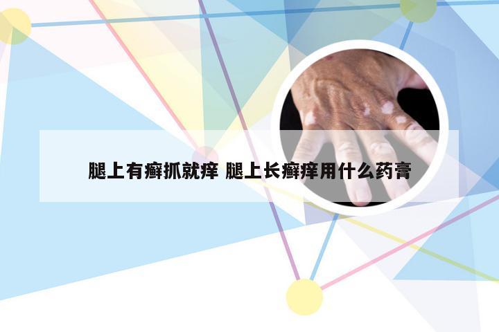 腿上有癣抓就痒 腿上长癣痒用什么药膏