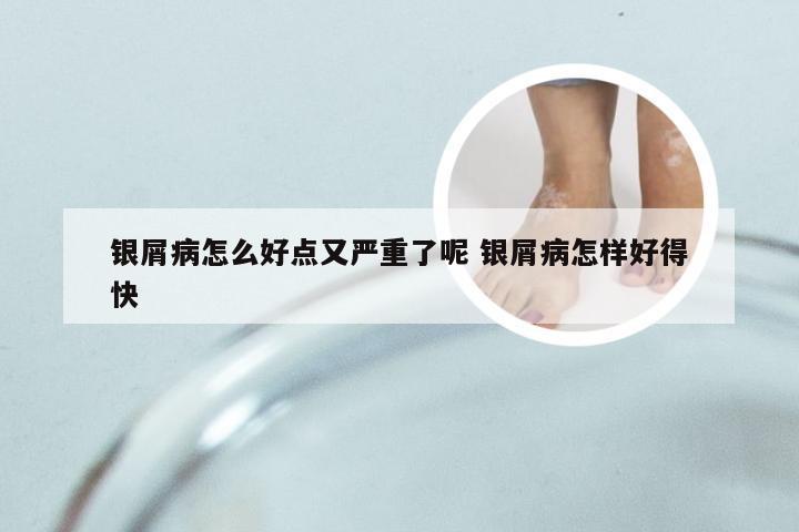 银屑病怎么好点又严重了呢 银屑病怎样好得快