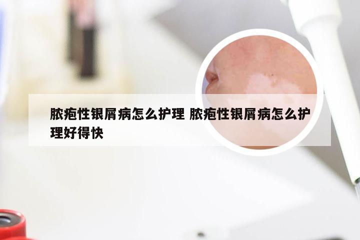 脓疱性银屑病怎么护理 脓疱性银屑病怎么护理好得快