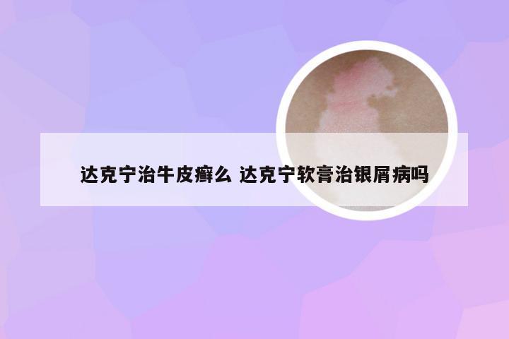 达克宁治牛皮癣么 达克宁软膏治银屑病吗