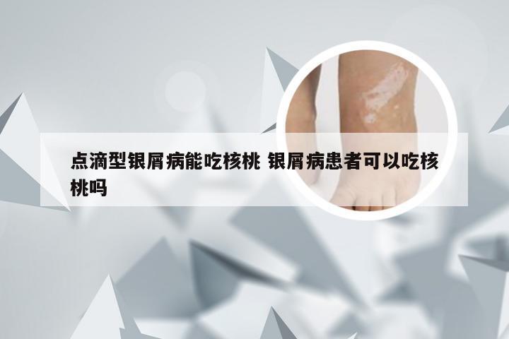 点滴型银屑病能吃核桃 银屑病患者可以吃核桃吗