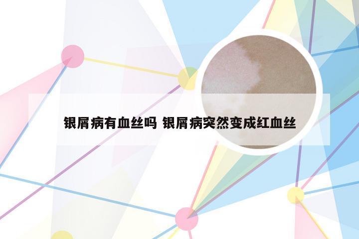 银屑病有血丝吗 银屑病突然变成红血丝