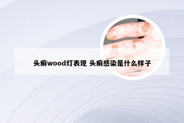 头癣wood灯表现 头癣感染是什么样子