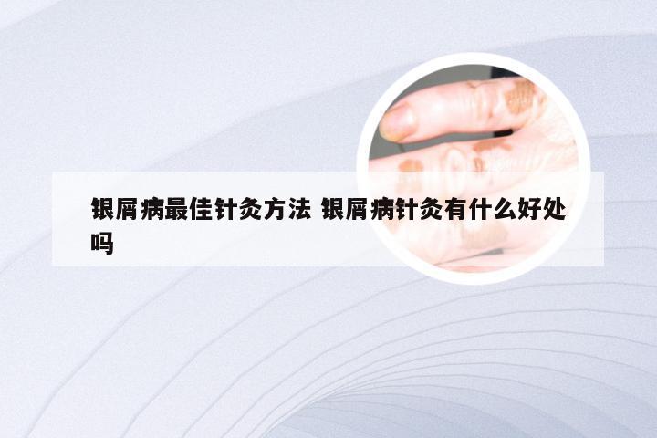 银屑病最佳针灸方法 银屑病针灸有什么好处吗