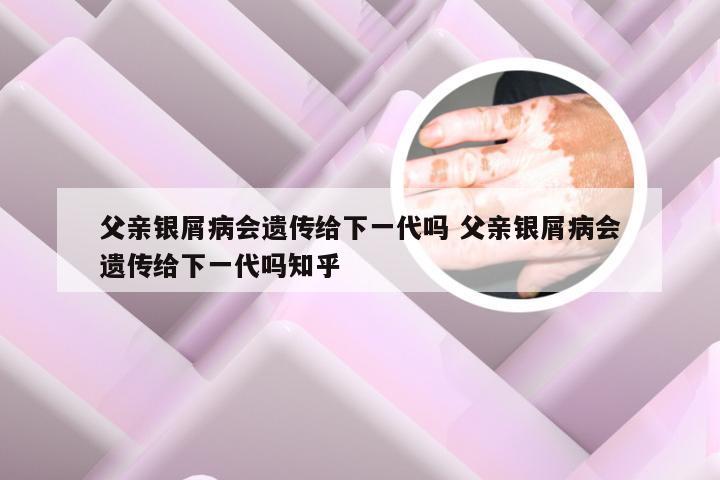 父亲银屑病会遗传给下一代吗 父亲银屑病会遗传给下一代吗知乎