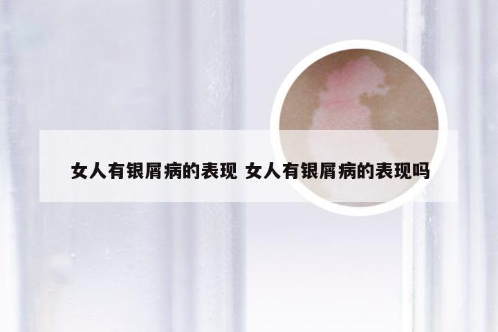 女人有银屑病的表现 女人有银屑病的表现吗