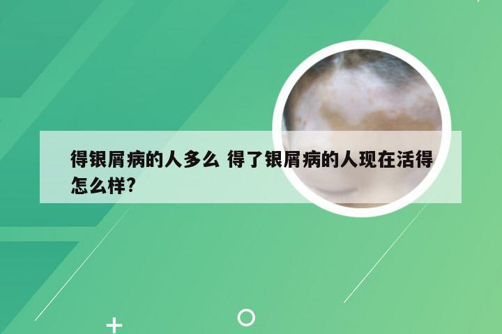 得银屑病的人多么 得了银屑病的人现在活得怎么样?