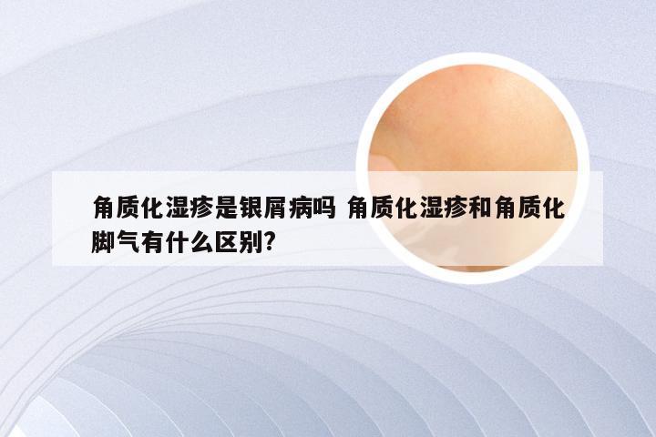 角质化湿疹是银屑病吗 角质化湿疹和角质化脚气有什么区别?