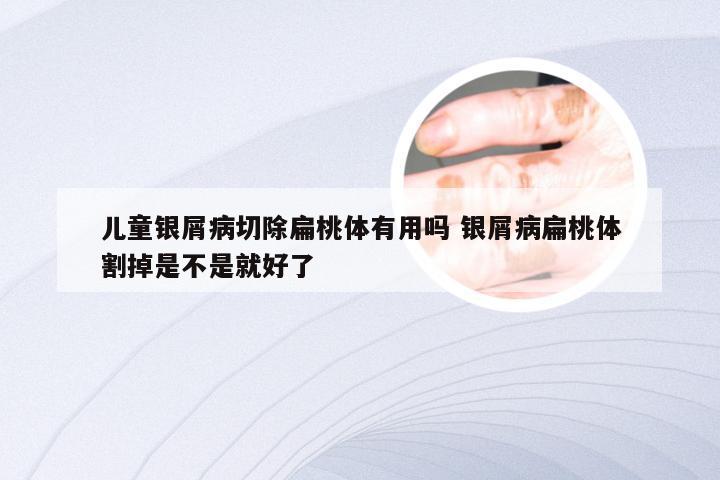 儿童银屑病切除扁桃体有用吗 银屑病扁桃体割掉是不是就好了