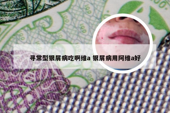 寻常型银屑病吃啊维a 银屑病用阿维a好