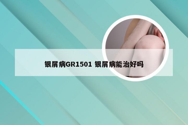 银屑病GR1501 银屑病能治好吗