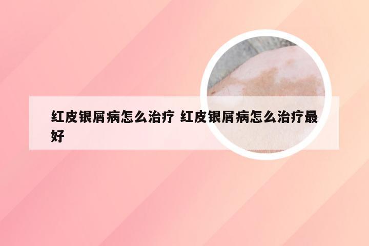 红皮银屑病怎么治疗 红皮银屑病怎么治疗最好