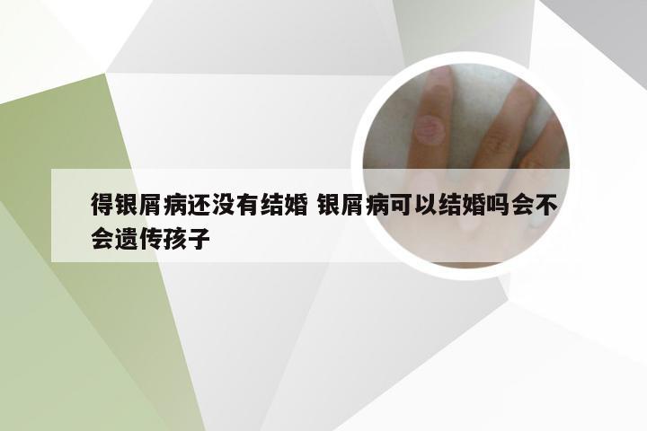 得银屑病还没有结婚 银屑病可以结婚吗会不会遗传孩子