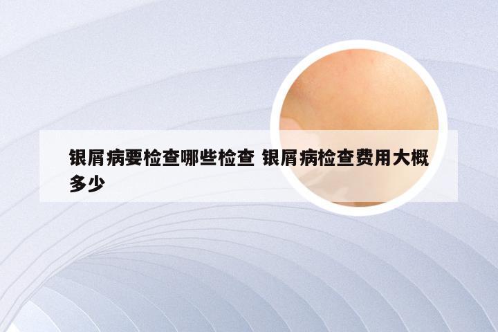 银屑病要检查哪些检查 银屑病检查费用大概多少