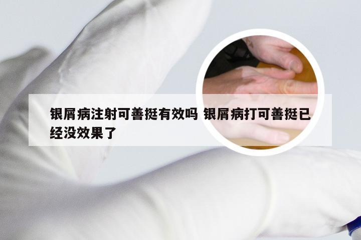 银屑病注射可善挺有效吗 银屑病打可善挺已经没效果了