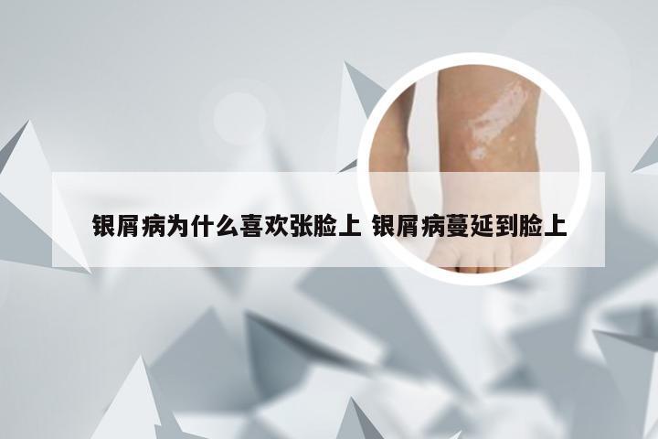 银屑病为什么喜欢张脸上 银屑病蔓延到脸上