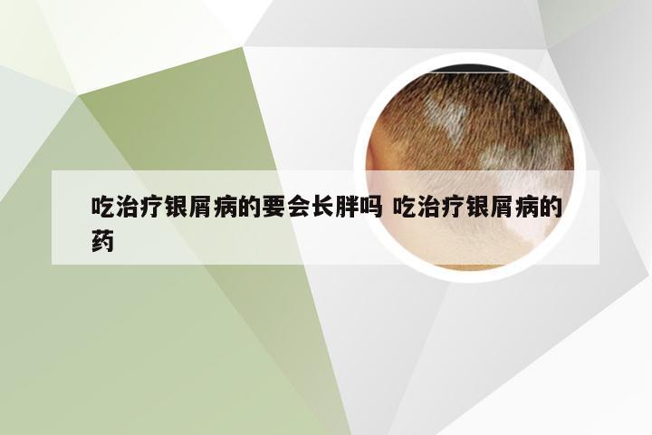 吃治疗银屑病的要会长胖吗 吃治疗银屑病的药