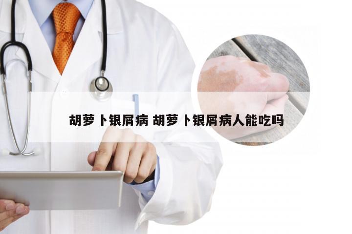 胡萝卜银屑病 胡萝卜银屑病人能吃吗