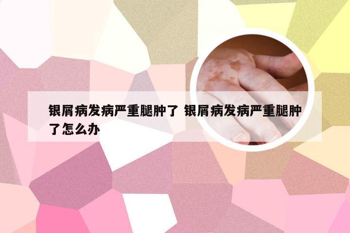 银屑病发病严重腿肿了 银屑病发病严重腿肿了怎么办