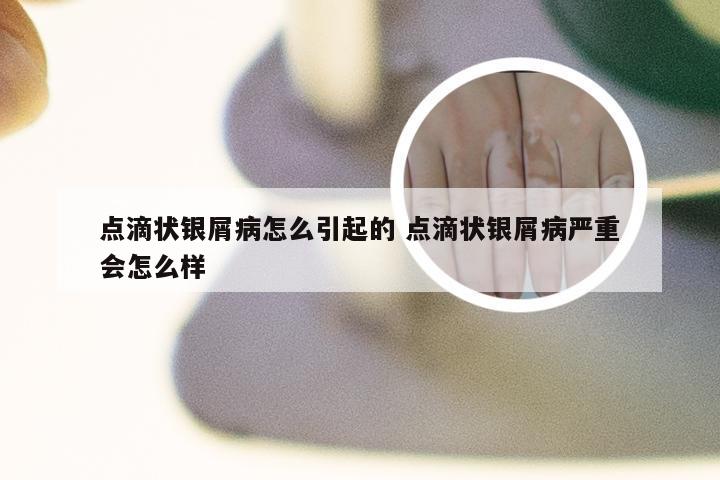 点滴状银屑病怎么引起的 点滴状银屑病严重会怎么样