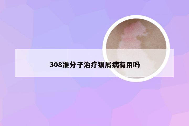 308准分子治疗银屑病有用吗