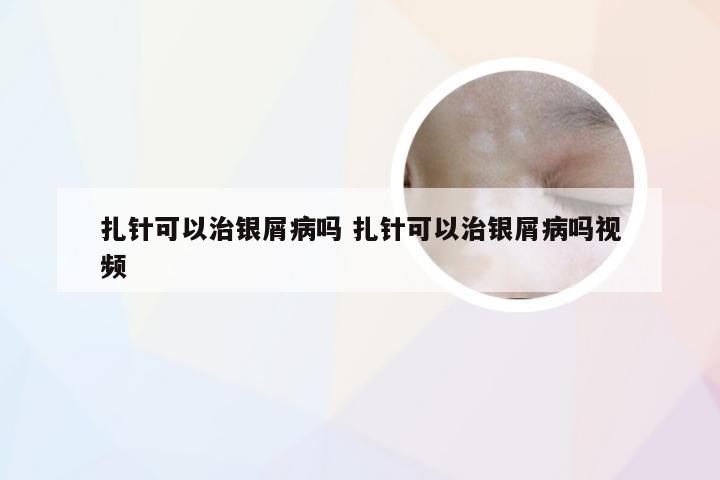 扎针可以治银屑病吗 扎针可以治银屑病吗视频