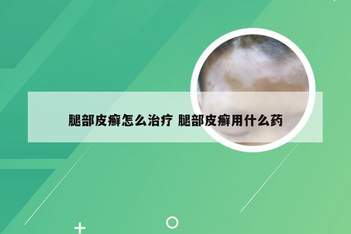 腿部皮癣怎么治疗 腿部皮癣用什么药