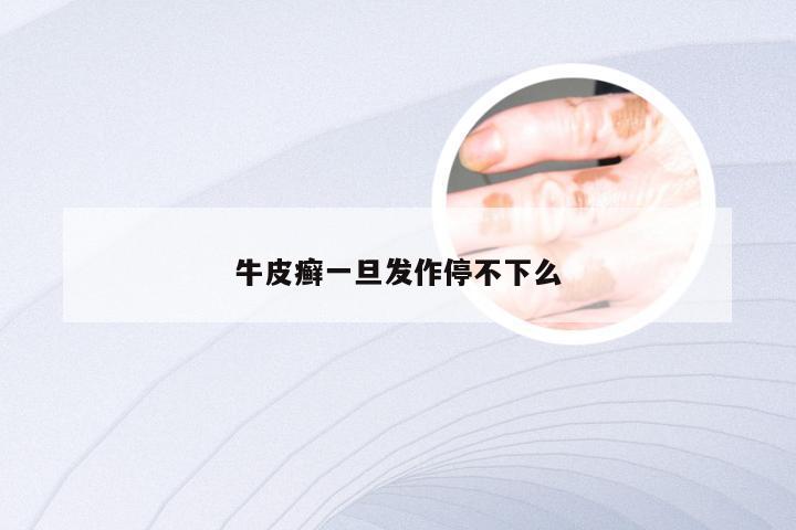 牛皮癣一旦发作停不下么