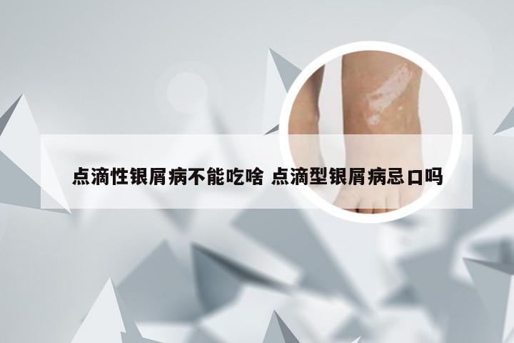 点滴性银屑病不能吃啥 点滴型银屑病忌口吗