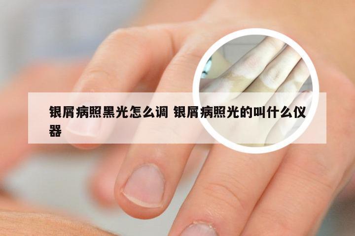 银屑病照黑光怎么调 银屑病照光的叫什么仪器