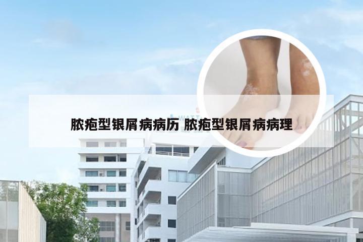 脓疱型银屑病病历 脓疱型银屑病病理