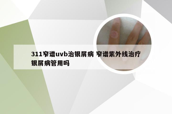 311窄谱uvb治银屑病 窄谱紫外线治疗银屑病管用吗