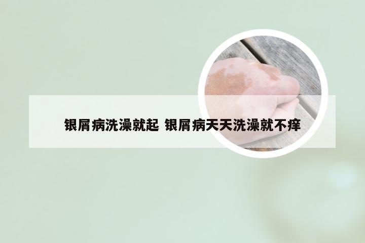 银屑病洗澡就起 银屑病天天洗澡就不痒