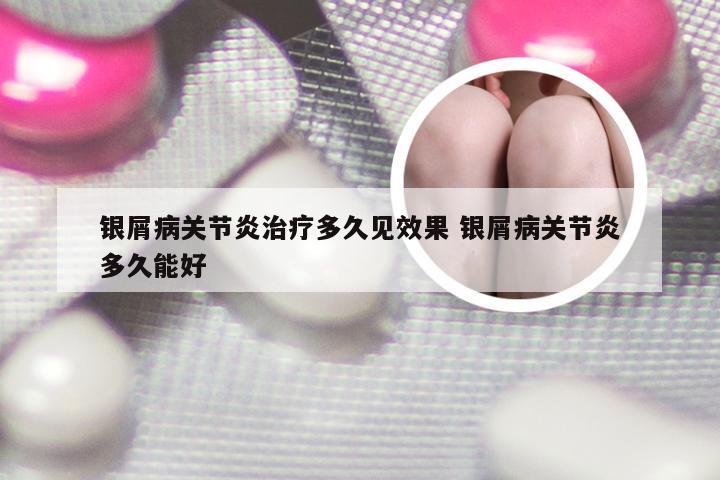 银屑病关节炎治疗多久见效果 银屑病关节炎多久能好