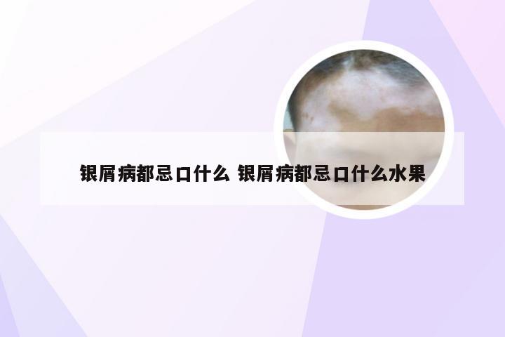 银屑病都忌口什么 银屑病都忌口什么水果