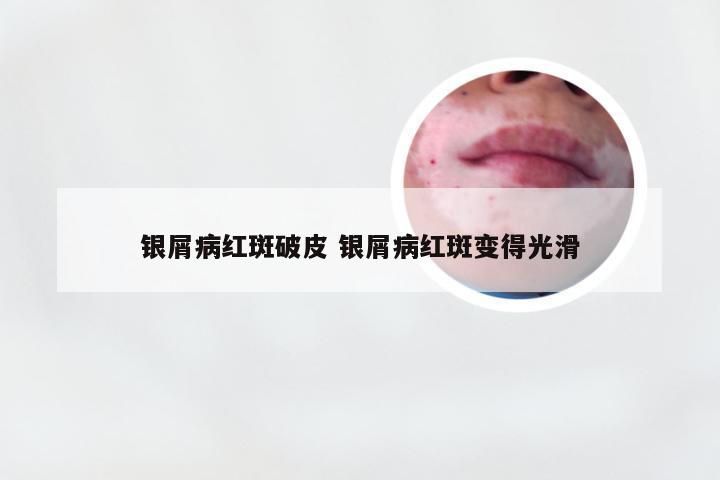 银屑病红斑破皮 银屑病红斑变得光滑