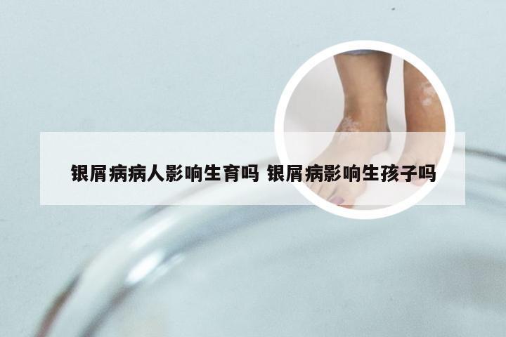 银屑病病人影响生育吗 银屑病影响生孩子吗