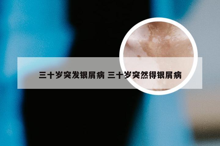 三十岁突发银屑病 三十岁突然得银屑病