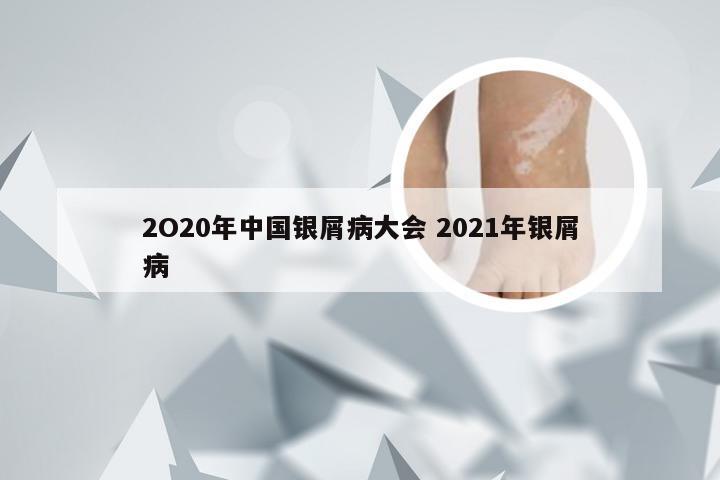 2O20年中国银屑病大会 2021年银屑病