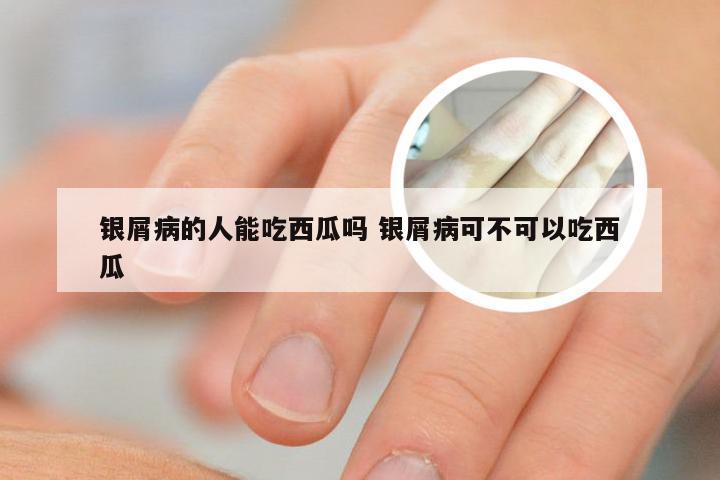 银屑病的人能吃西瓜吗 银屑病可不可以吃西瓜