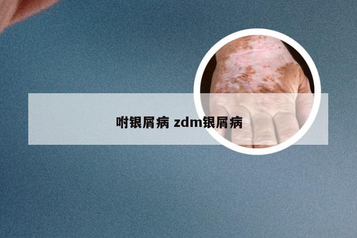 咐银屑病 zdm银屑病