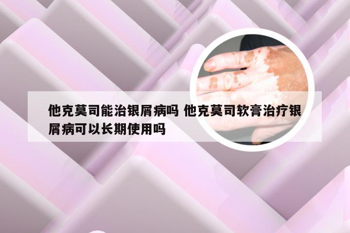 他克莫司能治银屑病吗 他克莫司软膏治疗银屑病可以长期使用吗