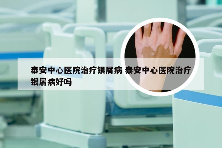 泰安中心医院治疗银屑病 泰安中心医院治疗银屑病好吗