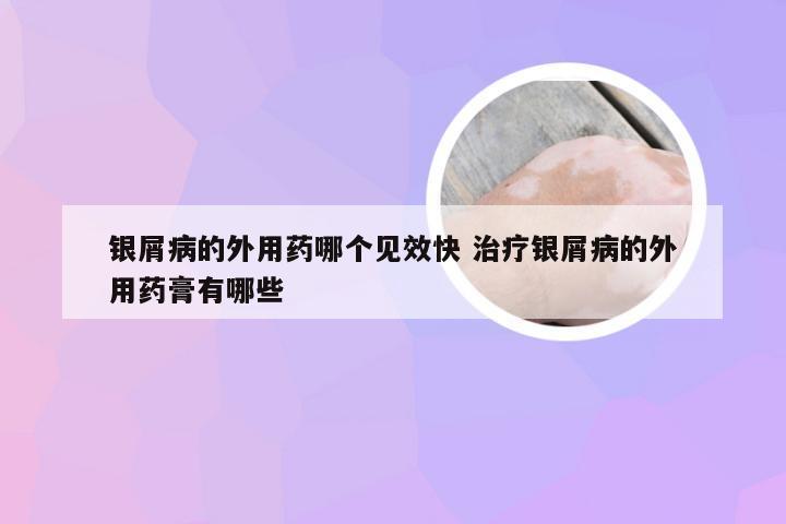 银屑病的外用药哪个见效快 治疗银屑病的外用药膏有哪些