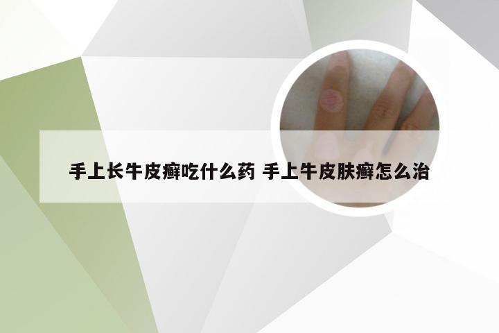 手上长牛皮癣吃什么药 手上牛皮肤癣怎么治