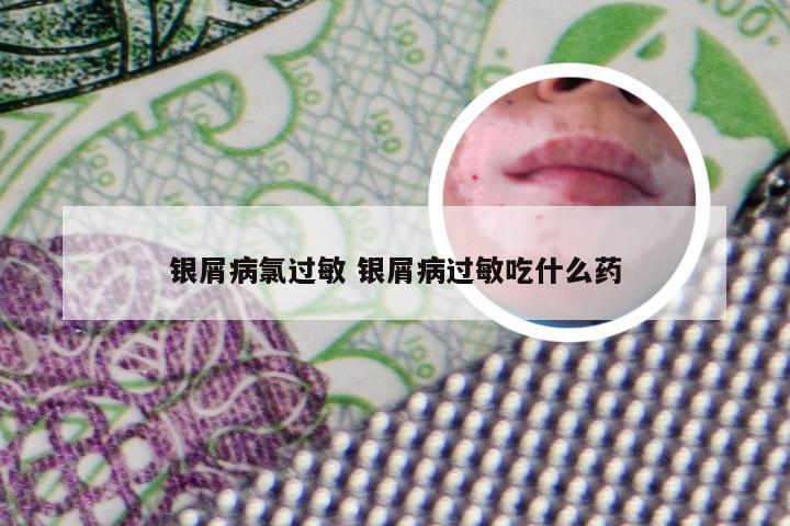 银屑病氯过敏 银屑病过敏吃什么药