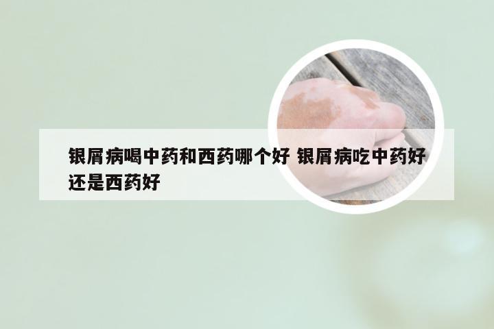 银屑病喝中药和西药哪个好 银屑病吃中药好还是西药好